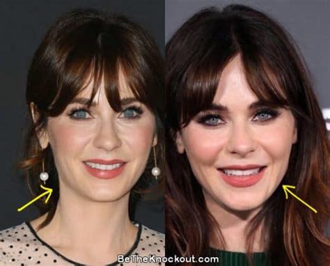 zooey deschanel filler|Zooey Deschanel Before and After